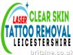 Laser Tattoo Removal Leicester